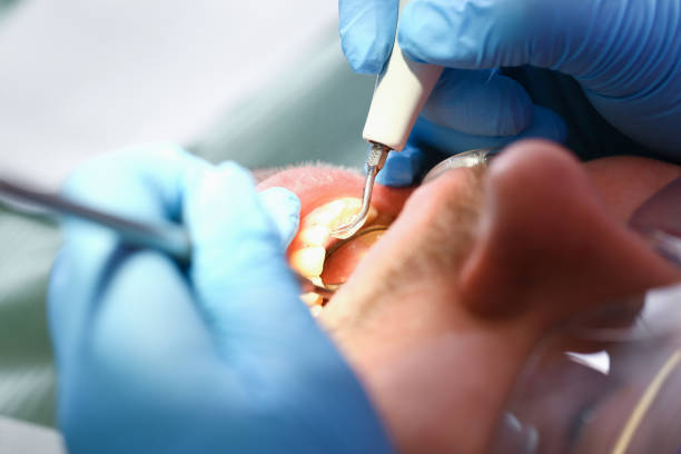 Best Dental Abscess Treatment in New London, TX